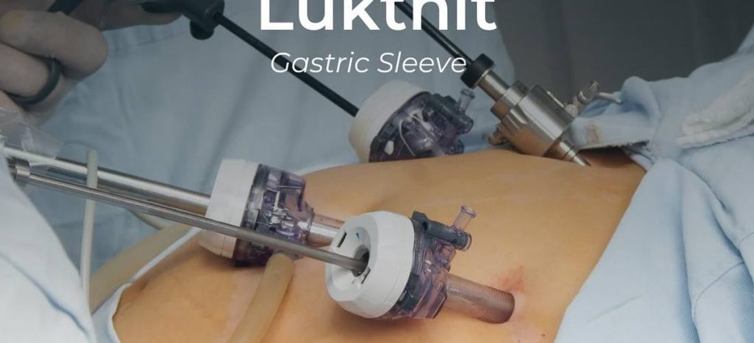 Zvogëlimi i lukthit (Gastric Sleeve) – Zgjidhje moderne në Rezonanca 2