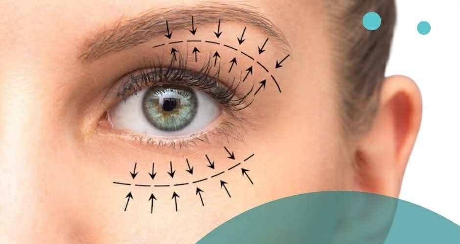 Sa zgjat dhe sa i vështirë është rikuperimi pas blefaroplastikës?