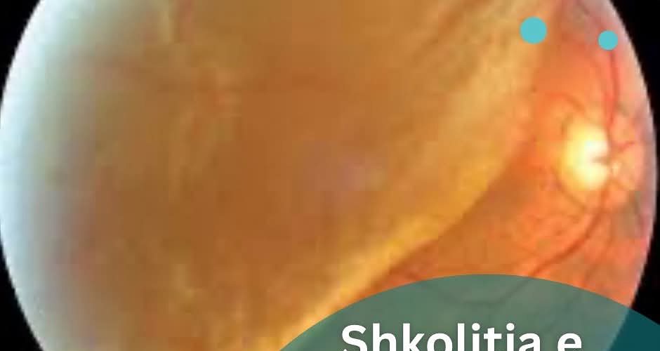 A e dini çfarë është shkolitja e retinës? – Klinika Gjermane e Syrit jep detajet!