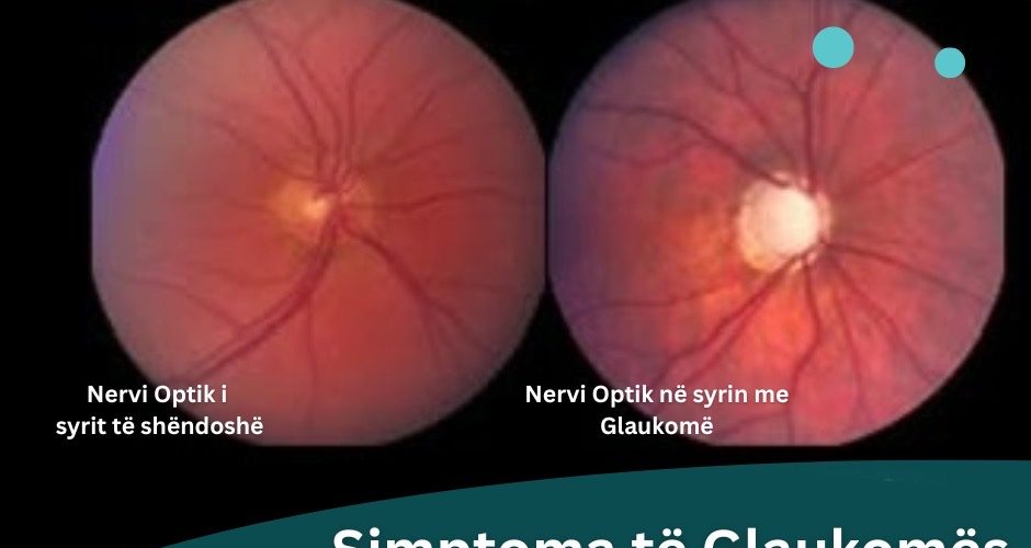 Simptoma të glaukomës që nuk duhet t’i injoroni sipas Klinikes Gjermane të Syrit