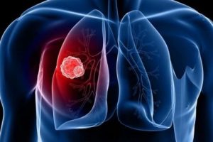 Raporti i OBSH: Tuberkulozi mbetet kërcënim serioz në Europë! 1 në 5 raste nuk raportohet