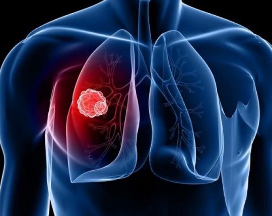 Raporti i OBSH: Tuberkulozi mbetet kërcënim serioz në Europë! 1 në 5 raste nuk raportohet