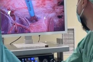 Falë kirurgjisë moderne në Spitalin Rezonanca 2, pacientja shpëton pas dekadash komplikimesh