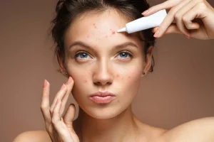 Antibiotikët kundër akneve: Kujt i ndihmojnë dhe sa gjatë mund të përdoren