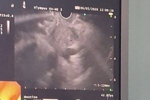 Realizohet për herë të parë biopsia e pankreasit përmes ultrasonografisë endoskopike në QKUK