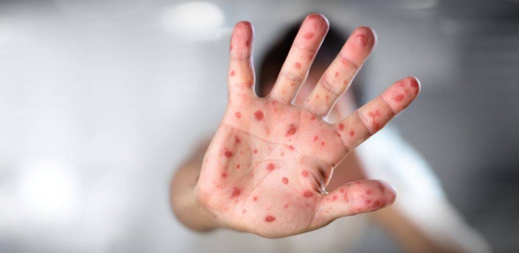 Rritet interesimi për vaksinim kundër fruthit – Mbi 1 mijë doza të dhëna në Prishtinë gjatë majit