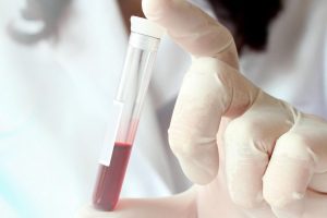 Një analizë gjaku me inteligjencë artificiale mund të zbulojë herët sëmundjet e mëlçisë
