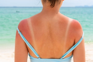 Kujdesi dermatologjik në verë: Si të mbrojmë lëkurën nga dëmtimet e diellit?