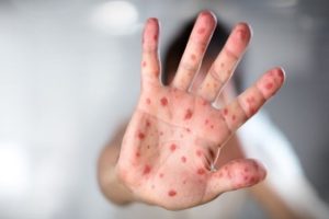 IKSHPK: Fruthi parandalohet, informohuni për vaksinën MMR