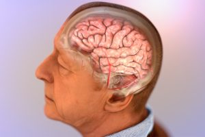 Si Sëmundja e Alzheimerit Prek jo Vetëm Mendjen por Edhe Trupin