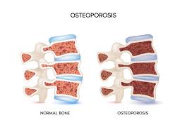 Osteoporoza: Sëmundja e heshtur që dobëson kockat