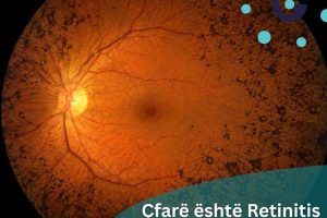 Retinitis Pigmentosa mund të shkaktojë humbje graduale të shikimit, Klinika Gjermane e Syrit bën thirrje për diagnostikim të hershëm