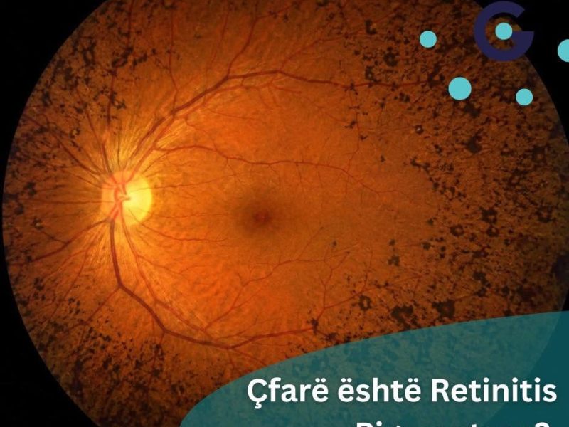 Retinitis Pigmentosa mund të shkaktojë humbje graduale të shikimit, Klinika Gjermane e Syrit bën thirrje për diagnostikim të hershëm