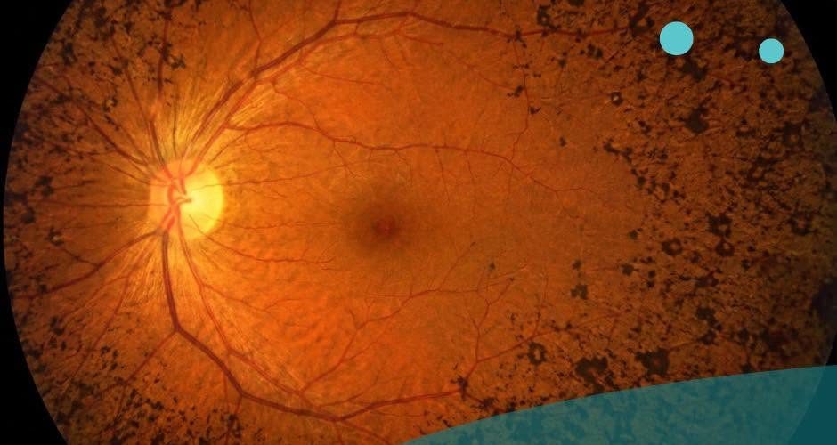 Retinitis Pigmentosa mund të shkaktojë humbje graduale të shikimit, Klinika Gjermane e Syrit bën thirrje për diagnostikim të hershëm