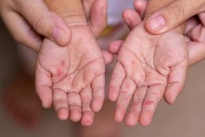 Rritet numri i rasteve me fruth në Kosovë, IKShPK apelon për vaksinim