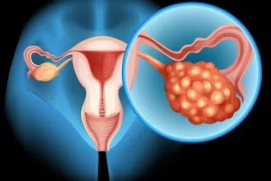PCOS – çrregullimi hormonal që shumë gra e kanë pa e ditur