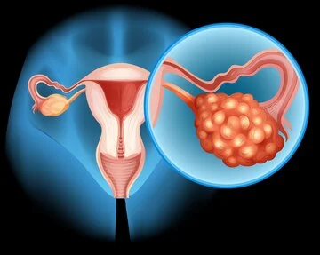 PCOS – çrregullimi hormonal që shumë gra e kanë pa e ditur
