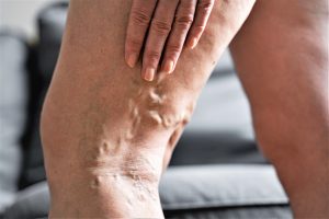 Venat e zgjeruara nuk janë vetëm problem estetik – kur duhet të kërkoni ndihmë?