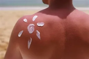 Çfarë duhet të bëni nëse digjeni rëndë nga dielli?