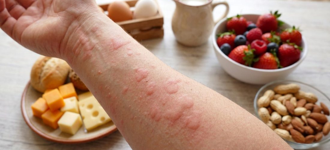 Alergjitë ndaj ushqimeve: si t’i njohim shenjat e para?