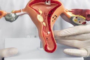 Endometrioza: pse diagnostikimi mund të vonohet me vite?