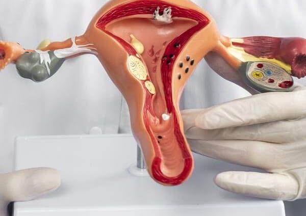 Endometrioza: pse diagnostikimi mund të vonohet me vite?